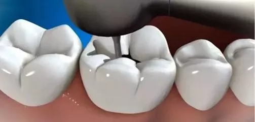 补牙医保怎么开药？