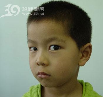 儿童斜视手术医保报销攻略